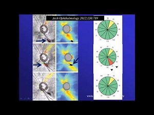 pitfalls when reading OCT glaucoma report