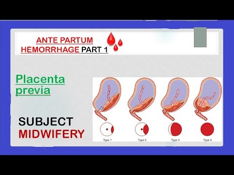 APH | ante partum hemorrhage | placenta previa | types of placenta previa