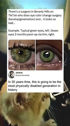 before and after eye color change surgery. #viral #memes