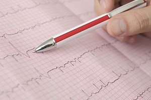 Atrial fibrillation: classification, symptoms, causes and treatment