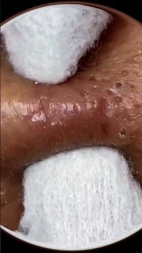 Heftiges Pickel Ausdrücken Extrem Neu | Blackhead Extraction