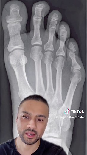 Kim Kardashian's Tailor's Bunion Explained