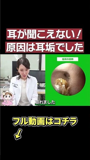 [ENT earpick] Removes earwax to the point that you can no longer hear