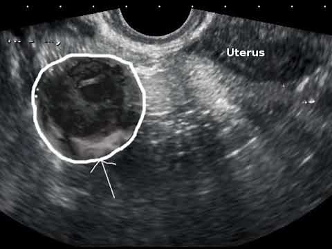Podcast 755: Tubo-Ovarian Abscess