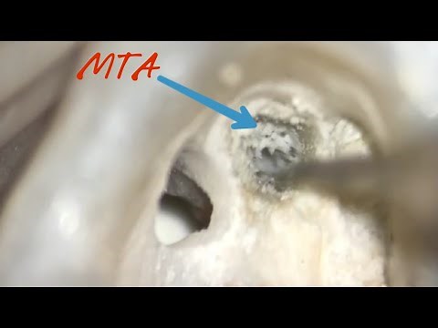 apical perforation management _ MTA mix and placement