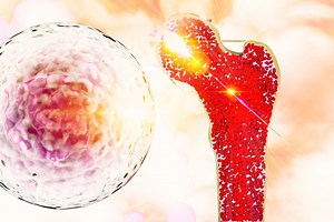 Ostéosarcome, cancer des os chez l'enfant : symptômes, survie et traitements