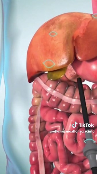 Cirugía de Vesícula: Proceso Laparoscópico y Extracción de Cálculos Biliares