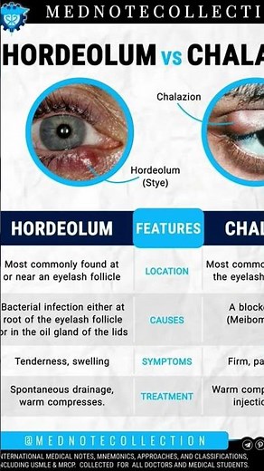 Hordeolum vs Chalazian #eyestructure #eyeparts #getsuccess #anatomy #eyestructure