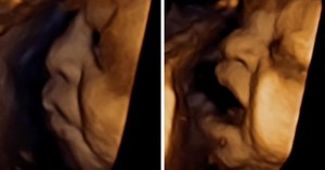 Study shows baby in the womb reacting to anaesthetic injection