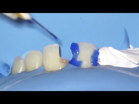 anterior Composite Restoration ( Class III & IV Composite Restoration)