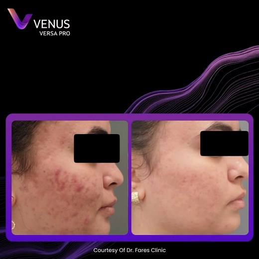 Deliver Clear Skin with Venus Versa™ Pro this Acne Awareness Month! 🌟 June is Acne Awareness Month, and it’s the perfect time to introduce your clients to the transformative power of Venus Versa™ Pro ACDual Acne treatments! Featuring advanced Dual-light IPL technology, Venus Versa™ Pro targets acne with precision. The blue light zeroes in on porphyrin produced by Propionibacterium acnes bacteria, effectively eliminating it. Meanwhile, the red light reduces inflammation and accelerates healing, 