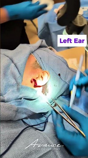 Ear Gauge Earlobe Repair | Avance Plastic Surgery Institute: Dr. Erez Dayan | Tahoe, NV
