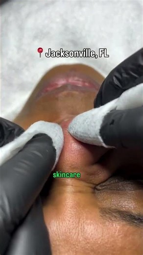 To be honest, the removal process for sebaceous filaments is easy, however it can be very