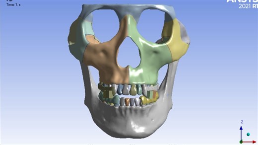 口腔单颗牙齿SolidWorks建模和种植体摆放，有限元分析