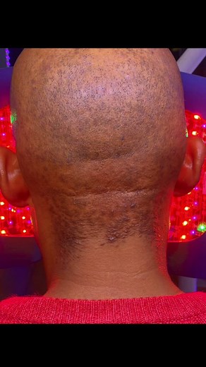 Hair Bumps: Before & After Transformation