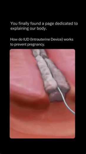 Explaining Our Body on Instagram: "The IUD (Intrauterine Device) is one of the most effective forms of birth control in the world — over 99% effective — and it works by creating a physical and biological environment that makes pregnancy extremely unlikely. There are two main types: copper IUDs and hormonal IUDs, and both prevent pregnancy before fertilization ever happens. 🔹 Copper IUD: The copper releases ions that make the uterus toxic to sperm. This stops sperm from swimming effectively, pre