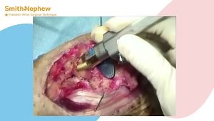 Total Wrist Arthroplasty: Techniques, Procedures, and Tips and Pearls from a Surgeon Expert