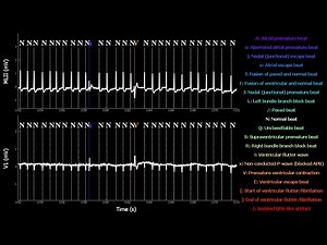 RealTime Electrocardiogram MIT-BIH Arrhythmia Database N°210 with tag annotations.