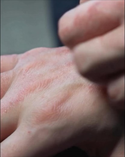 Struggling with psoriasis, eczema, or atopic dermatitis? 🌿 VedicDerm brings your ultimate healing solution for complete Psoriasis care. ✨ Reclaim smooth, healthy skin and boost your confidence today! 💪 ✔️ Provides fast relief from itching & dryness ✔️ Helps reduce redness, scaling, and irritation ✔️ No steroids, no parabens, no side effects ✔️ Trusted by 40,000 users across India Feel the difference in just 7 days! | VedicDerm