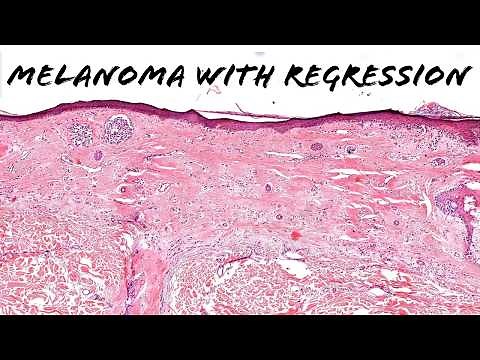 Melanoma with regression (mimicking recurrent nevus & dysplastic nevus) pathology dermatopathology