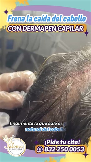 27K views · 1.2K reactions | Dermapen Capilar enn Paloma Clinic...