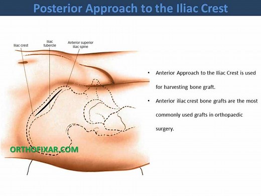 Anterior Approach To The Iliac Crest
