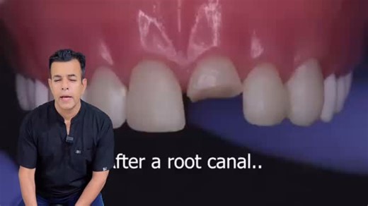 Rajat Sachdeva on Instagram: "When a tooth undergoes root canal treatment and has lost significant structure, a post and core system is used to help retain a crown. The two main types of posts are fiber posts and metal posts. 🔹 Fiber Post Material: Made from reinforced glass or carbon fiber embedded in a resin matrix. Aesthetic: Tooth-colored, ideal for anterior restorations. Flexibility: Has a modulus of elasticity similar to dentin, which helps reduce the risk of root fracture. Bonding