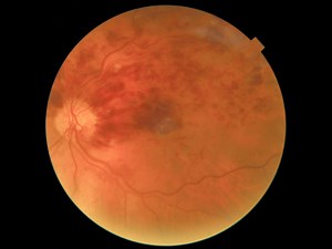Retinal Vein Occlusion