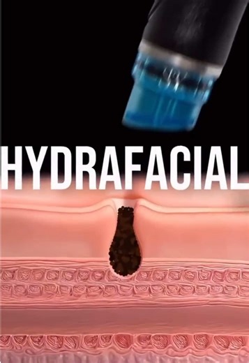 HydraFacial every 4–6 weeks = consistent glow ✨ Regular treatments help deeply cleanse pores, boost hydration, smooth texture, and support healthy cell turnover. Safe, gentle, and effective for all skin types even sensitive skin. Your skin deserves maintenance, not just a moment. 🌹 #hydrafacial