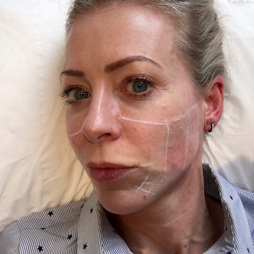 The Truth About Ultherapy: Updated Treatment Review