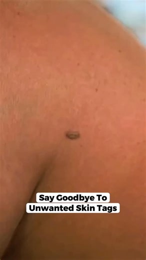 Simple Tech Finds | Amazon Finds on Instagram: "✅ Comment “SKIN” and we’ll DM you the link — or shop directly from our LINK IN BIO @simpletechfinds Tired of skin tags that snag on clothing, cause discomfort, and affect your confidence? Meet the MicroNeedle Botanic Patch — a simple at-home patch made for skin tag care, with no pain or downtime. Made with precision microneedle technology and a botanical-focused formula, this patch targets skin tags gently and comfortably. 🔥 Limited-Time Offer 💸 