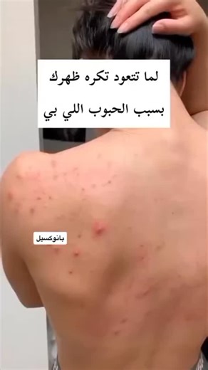 𓆩💗𓆪Z𝒂𝒉𝒓𝒂𝒂A𝒍_𝒓𝒆𝒌𝒂𝒃𝒆𝒚𓆩💗𓆪 on Instagram‎: "مشاكل حبوب الضهر و الوجه و الصدر تعاني منهة هواي بنات و حلهة بغسول واحد من بانوكسيل بتركيز ١٠٪؜ لحبوب الضهر و الصدر وتركيز ٤٪؜ لحبوب الوجه شوفين عليه فرق من اول اسبوع يتخلص من كل البكتريا الي موجوده بجسمج وينطيج جسم ناعم بدون اي حبوب ـــــــــــــــــــــــــــــــــــــــــــــــــــــــــــــــــــــــــــــــــ 🚘 يوجد خدمة توصيل لجميع محافظات العراق 🚘 #بانوكسيل #اكبر_تجمع_لبنات_العراق🇮🇶🇮🇶🇮🇶 #مشاهير #هاشتاك_العراقراق_السعودية_قط
