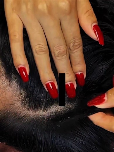 Removal huge dandruff #DandruffScratching #ItchyDryScalp #HugeFlakes #Dandruff #dandrufftreatment #satisfying #dandruffremoval Disclaimer: Videos do not show original Dandruff, they are used for education purpose. Thank You,,,, | The Filmy