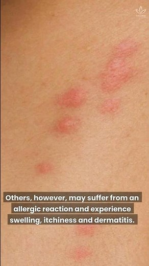 What Bit Me? How To Identify The Most Common Bug Bites #shorts