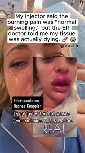 THE DARK SIDE OF TOX on Instagram: "Take two. 🎬 Sharing for awareness. We made a correction and added a different clip. Accuracy matters here. What hasn’t changed is the reality. People are being injured, dismissed, and told to tolerate pain that signals damage. We receive panicked emails weekly from people with fillers gone wrong. Just like this. Rachael Knappier was laughed at by nurses. She was in excruciating pain. She was dismissed by NHS. It was not Botox. Fillers also carry docume