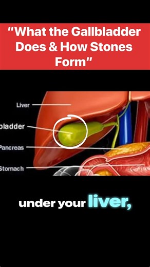 Understanding Gallstones: How Your Gallbladder Works and Why Stones Form