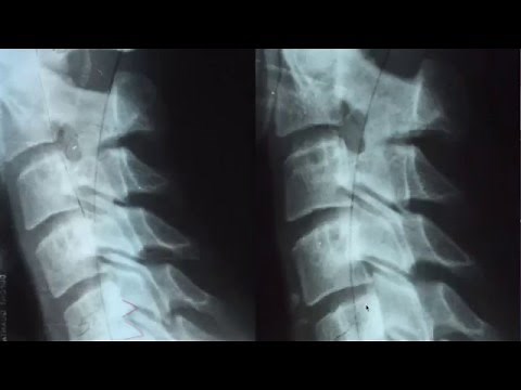 Proof that you can fix bone spurs in the spine without surgery