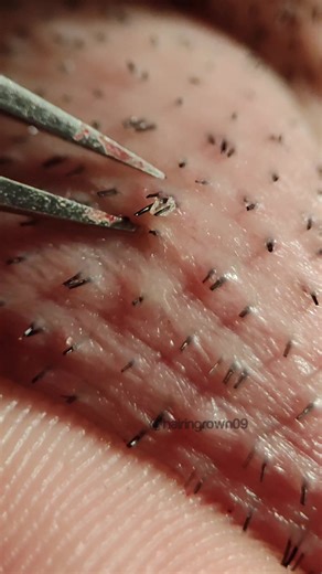 Pimple Extractions & Ingrown Hair Pull | Tweezers & Waxing Videos