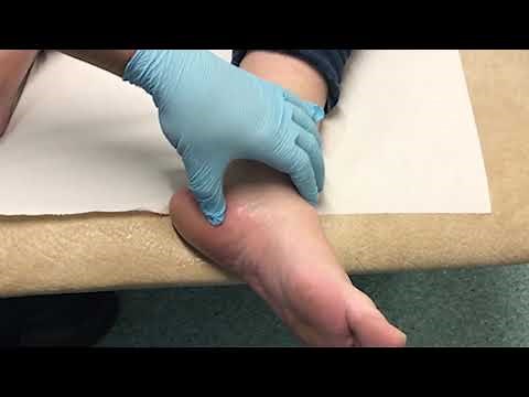 Plantar fasciitis steroid injection