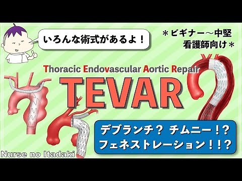 【TEVARの術式をマスターしよう！】デブランチ？チムニー？フェネストレーション？