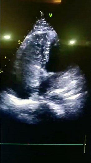Contrast Echo Right side heart in echocardiography