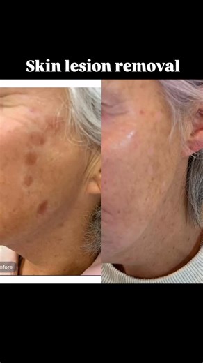 CRYOPEN ❄️ the power of N20 (nitrous oxide) Cryotherapy or “freezing” treatment delivers a non invasive way to break down abnormal or unwanted tissue. A safe and really effective treatment to reduce dark pigmentation spots 🤎 warts, verruca, seborrheic keratoses and cherry angiomas. 🍒 This treatment delivers precise results without damaging surrounding tissue. Sometimes requires 2 sessions, price starts at £45. #medispa #colchesterbeauty #essexclinic #skinlesions #skinlesionremoval #cryopen | A