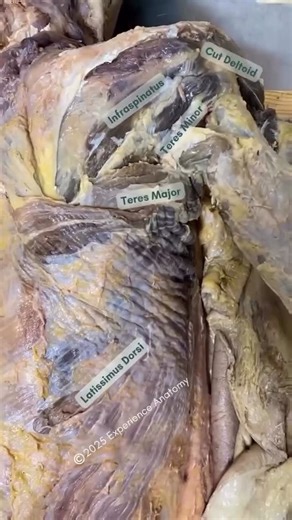 Mobility Tips | Joint Relief Daily on Instagram: "💥𝐒𝐜𝐚𝐩𝐮𝐥𝐨𝐡𝐮𝐦𝐞𝐫𝐚𝐥 𝐑𝐡𝐲𝐭𝐡𝐦💥 —— 📚When we raise our arms overhead, the motion is shared between the shoulder joint (glenohumeral joint) and the scapula moving on the rib cage (scapulothoracic joint). This coordinated pattern is known as scapulohumeral rhythm and allows for smooth, efficient motion when reaching overhead. 🔎Classically, this rhythm has been described as about two-thirds of the movement coming from the glenohumeral