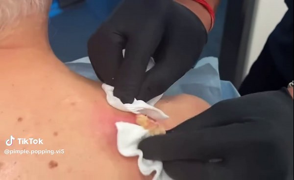 #PimplePopping #Satisfying #OddlySatisfying #DrPimplePopper #CystRemoval #AcneRelief #SatisfyingVideos #SkinCareRoutine #PimplePop #BlackheadRemoval #SatisfyingASMR #GrossButGood #AcneTreatment #ClearSkinJourney #Dermatology #fyp