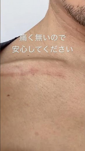 【鎖骨骨折プレート除去手術】リハビリもがんばろう！