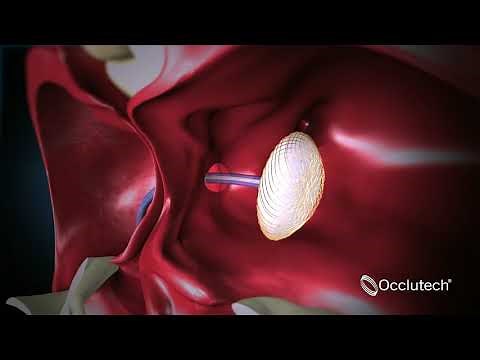 心房中隔欠損カテーテル治療_動画