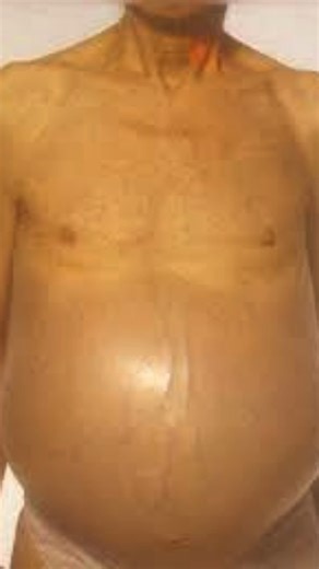 When the Liver Reaches a State of Collapse - Symptoms Your liver is dying #reel #reels #liverfailure #liverdisease #liverdamage #endstageliverdiseasesigns When the liver reaches a state of collapse, the body shows severe distress due to the total loss of filtration. You may see massive abdominal swelling (ascites) because of extreme fluid pressure, or vomiting blood due to ruptured veins in the esophagus. Deep jaundice, dark urine, and pale stools occur as a result of bile failure. Finally, extr