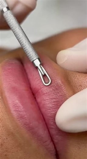 black heads remove for lips #foryou #facecleaning #creatorsearchinsights #faceclean #viral