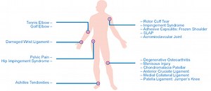 Platelet Rich Plasma (PRP) Therapy - Texas Spine and Sports Therapy Center