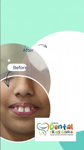 Smile Transformation: 10-Year-Old Girl Gains Confidence with Braces in 6 Months